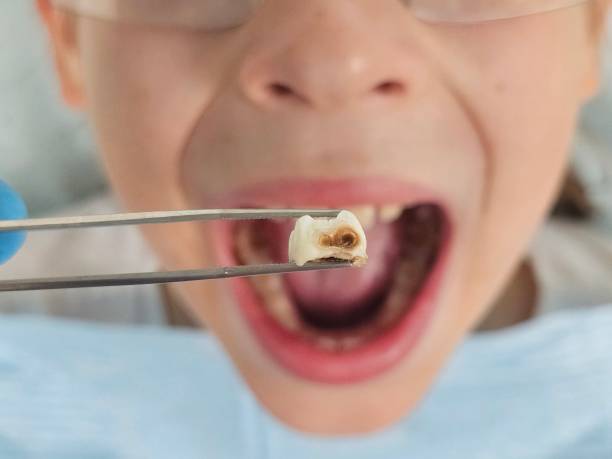 Best Chipped Tooth Repair Near Me  in Umatilla, FL